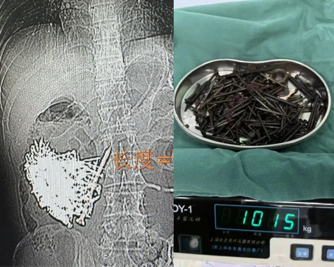 Doktor Keluarkan 1kg Paku Dari Perut Lelaki