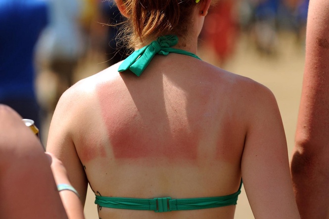 Skin cancer warning as one in nine Britons admit to deliberately burning themselves to tan