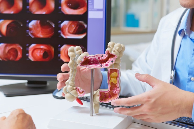 FDA approves another blood test for colon cancer screening