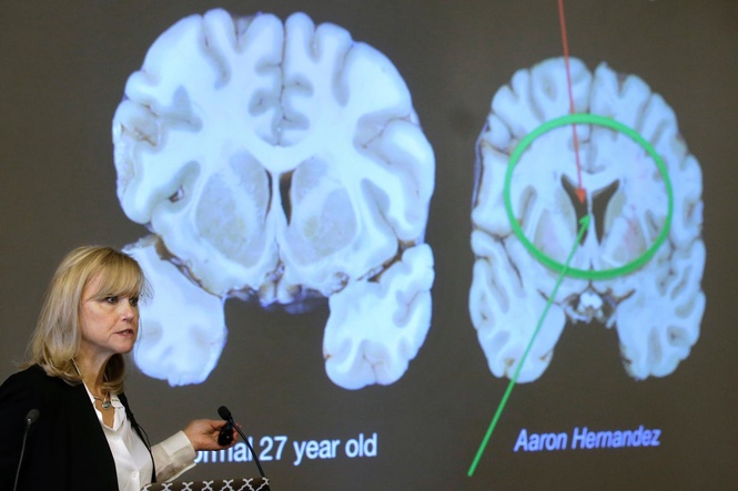 One in four NFL players could get CTE, alarming new study finds