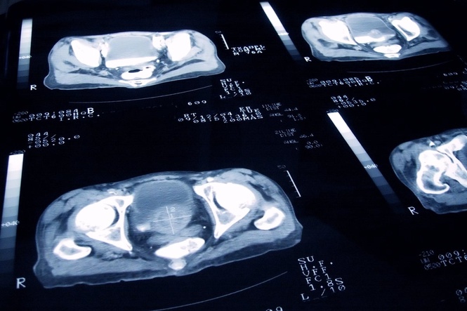Here’s what actually happens during a prostate cancer screening