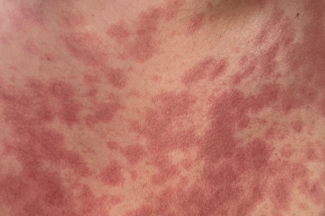 Meningitis B: The symptoms to know as fourth case confirmed in Reading