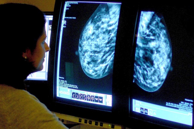 When should you get a mammogram? The latest information amid conflicting advice