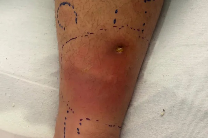 Florida family raises alarm after teen contracts flesh-eating bacteria