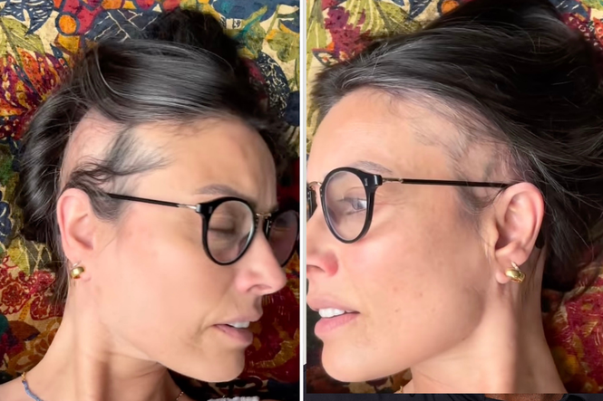 Melanie Sykes reveals extent of hair loss after going ‘two-thirds bald’