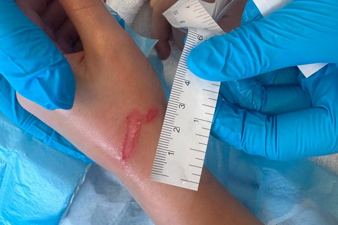 Online ‘squishy’ trends leaves children with painful burns
