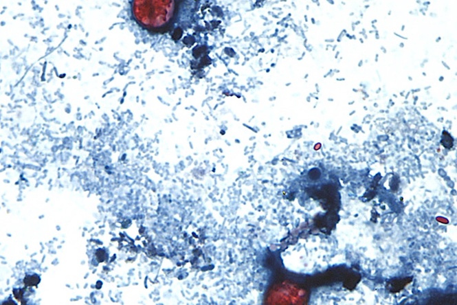 Cyclosporiasis outbreak: Symptoms to watch for as ‘explosive diarrhea’ cases climb in US