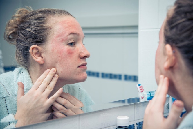 Common eczema treatment could actually make it worse, study suggests