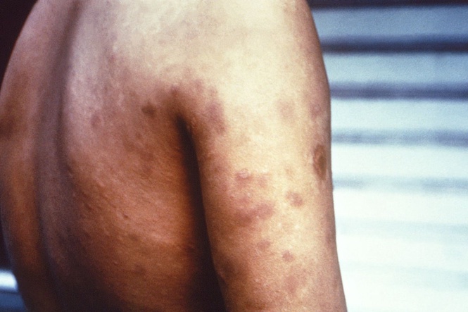 Leprosy cases are on the rise in Florida. Here’s how to reduce your risk