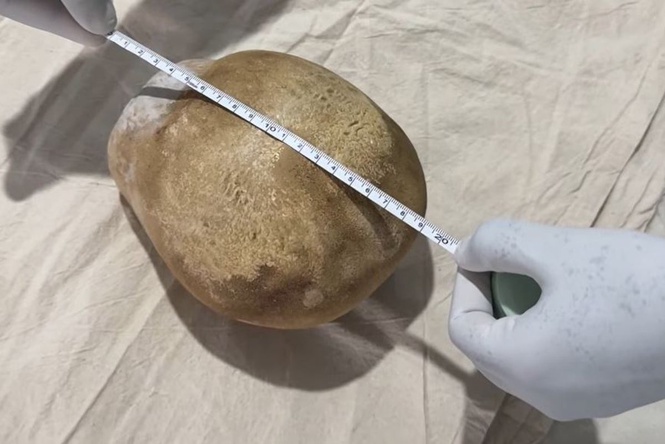Surgeons in Sri Lanka remove man’s ostrich egg-sized bladder stone