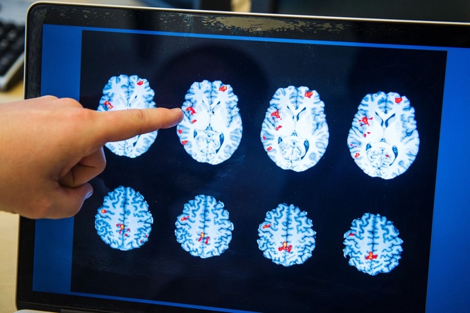 Hope for thousands after breakthrough in brain tumour treatment