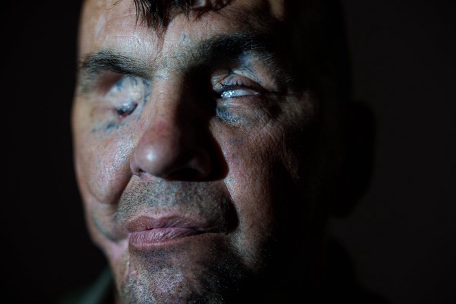 A Ukrainian soldier lost his sight in war. Now he hopes to see his children again