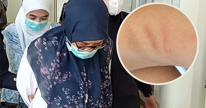 Guru taska didenda selepas kanak-kanak autistik dipukul menggunakan hanger