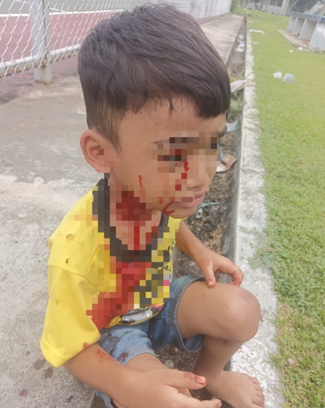 Image from: Lagi kanak-kanak parah digigit anjing liar