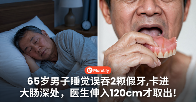 睡觉误吞2颗假牙!65岁男子假牙一路掉进大肠,医生伸入120cm才顺利取出!