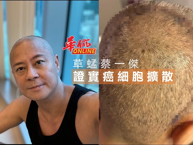 草蜢蔡一傑 證實癌細胞擴散