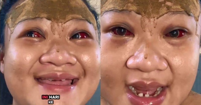 Image from: Pengorbanan ibu! Tular 6.5 juta, mata merah menyala lepas bersalin, wanita ini pecah pembuluh darah gara-gara tersilap meneran